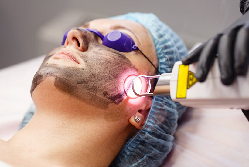Hollywood Laser Peel