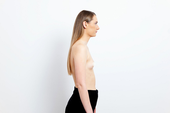 Kateřina před zákrokem v MEDICOM Clinic